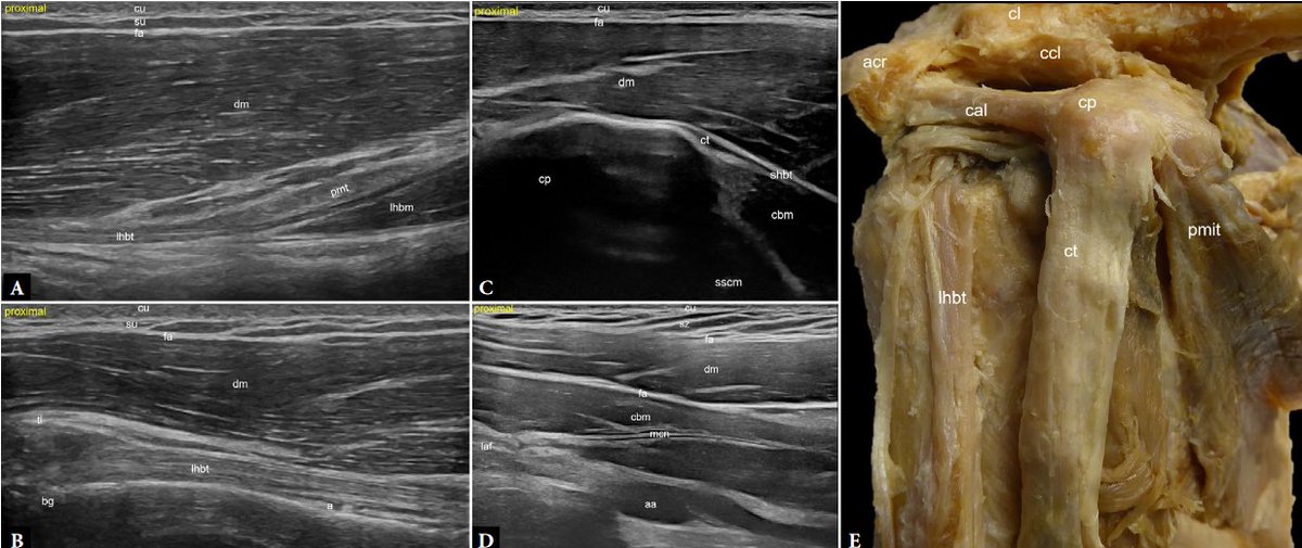 Advanced high-resolution musculoskeletal ultrasound: a histology- and anatomy-guided approach for improved imaging of the shoulder. 
Part 2: Anterior and lateral shoulder

FREE DOWNLOAD:
jultrason.pl/artykul.php?a=…

FREE DOWNLOAD Part 1:
x.com/Rheumatology/s…

I would like to thank