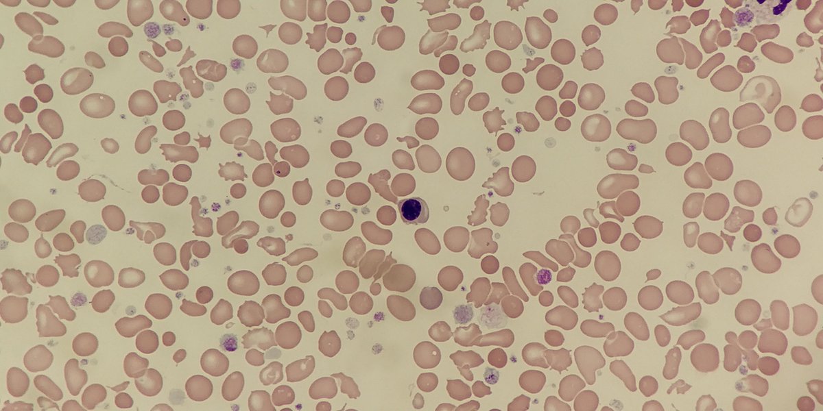 BloodScientist's tweet photo. #FilmFriday

Though there is a huge variation in size of the red cells (increased RDW), the MCV was normal. Why?

#OnlyCells #Anisocytosis #RedCells https://t.co/OSBsfKJraX