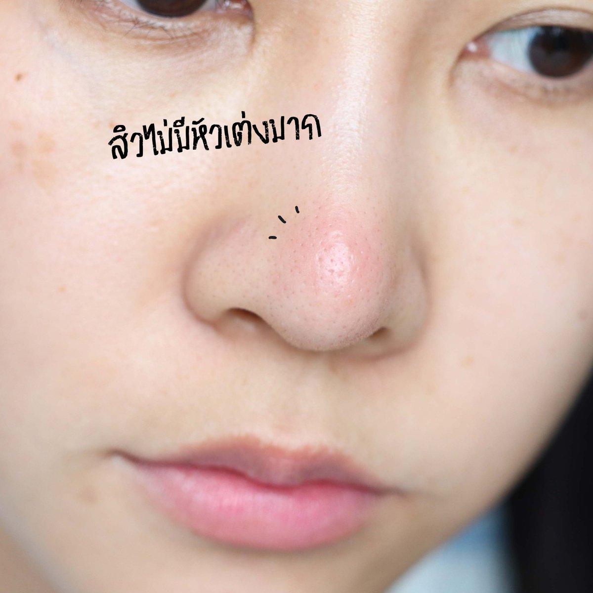 สิวไม่มีหัวกำลังอักเสบเต่งไม่ไหว ใช้ Effaclar Duo+M ของ La Roche-Posay ทากลางคืน ตอนเช้าชียุบบบบบ!! แล้วสูตรปรับใหม่เนื้อดีขึ้น สิวแห้งไวขึ้น เค้ามี Phylobioma ช่วยจัดการปัญหาสิวได้อย่างตรงจุดเลย ใครกังวลเรื่องสิวอยากให้ลองจริง  #LaRochePosayTH #Effaclar #ลาโรชโพเซย์ #เอฟฟาคลาร์ #เอฟฟาคลาร์ดูโอพลัสเอ็ม #ลดสิว #รอยสิว #EffaclarDuo #ผิวมัน