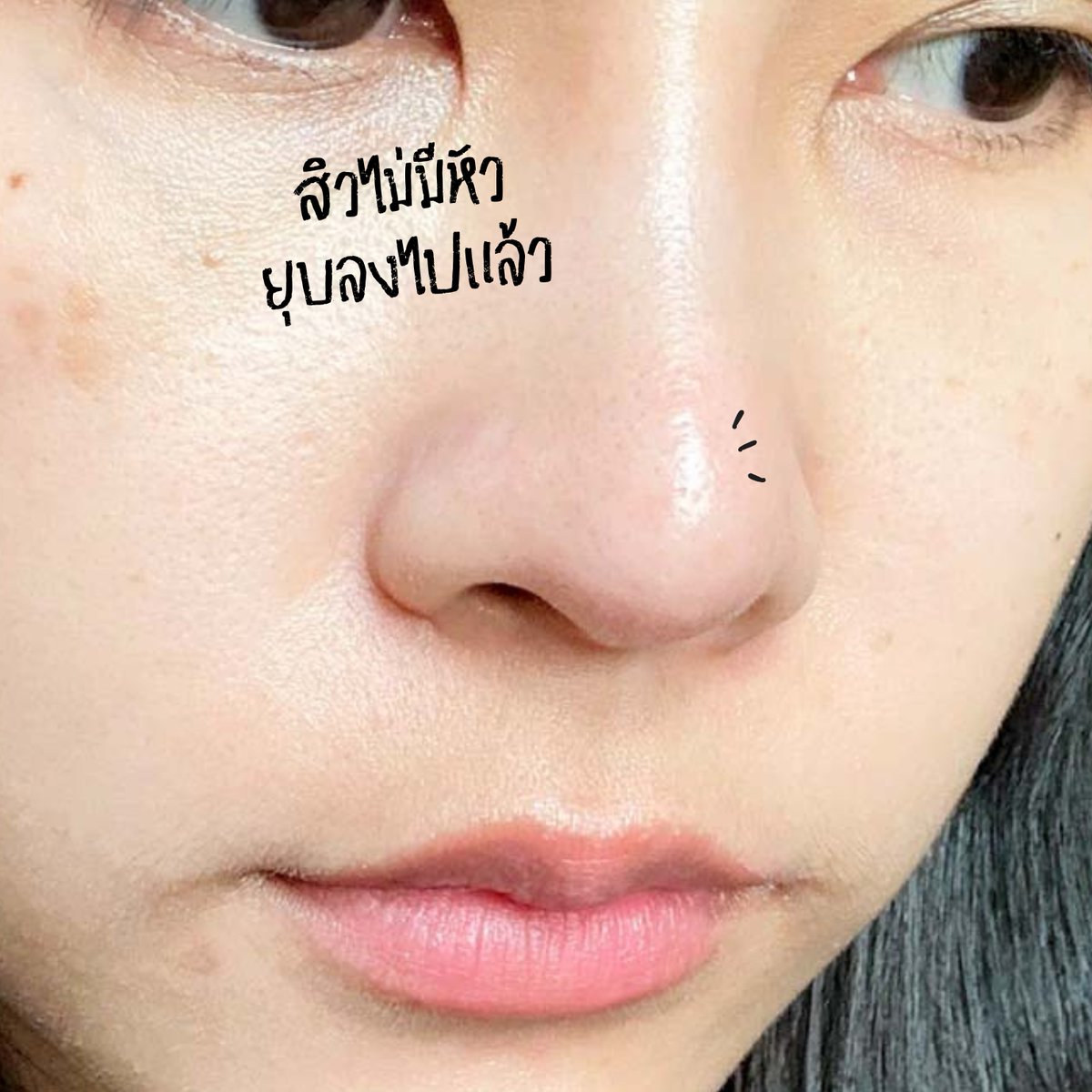 สิวไม่มีหัวกำลังอักเสบเต่งไม่ไหว ใช้ Effaclar Duo+M ของ La Roche-Posay ทากลางคืน ตอนเช้าชียุบบบบบ!! แล้วสูตรปรับใหม่เนื้อดีขึ้น สิวแห้งไวขึ้น เค้ามี Phylobioma ช่วยจัดการปัญหาสิวได้อย่างตรงจุดเลย ใครกังวลเรื่องสิวอยากให้ลองจริง  #LaRochePosayTH #Effaclar #ลาโรชโพเซย์ #เอฟฟาคลาร์ #เอฟฟาคลาร์ดูโอพลัสเอ็ม #ลดสิว #รอยสิว #EffaclarDuo #ผิวมัน