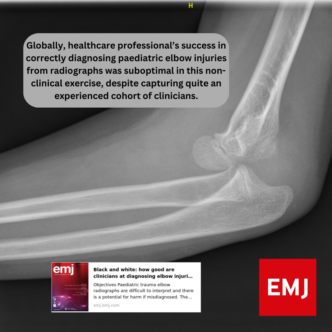 Emergency Medicine Journal (@emergencymedbmj) on Twitter photo #OnlineFirst
Black and white: how good are clinicians at diagnosing elbow injuries from paediatric elbow radiographs alone?
This prospective international study was conducted online via the #FOAMed platform <a href="/DFTBubbles/">Team DFTB</a>
emj.bmj.com/content/early/…
<a href="/drsarahedwards/">Dr Sarah Edwards</a> <a href="/TessaRDavis/">Tessa Davis</a> #OnlineFirst
Black and white: how good are clinicians at diagnosing elbow injuries from paediatric elbow radiographs alone?
This prospective international study was conducted online via the #FOAMed platform <a href="/DFTBubbles/">Team DFTB</a>
emj.bmj.com/content/early/…
<a href="/drsarahedwards/">Dr Sarah Edwards</a> <a href="/TessaRDavis/">Tessa Davis</a>