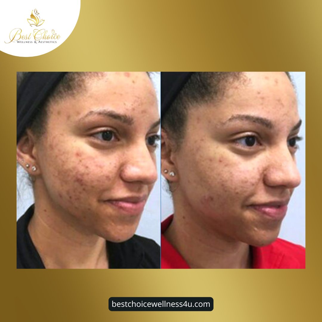 BWellness4u's tweet photo. ✨ Transform Your Skin with Microneedling! ✨

Check out this stunning before and after from one of our happy clients! Microneedling helps improve:
✔️ Skin texture
✔️ Fine lines &amp; wrinkles
✔️ Acne scars
✔️ Overall radiance

Ready to achieve your skincare goals? https://t.co/YlTrAmLLiF