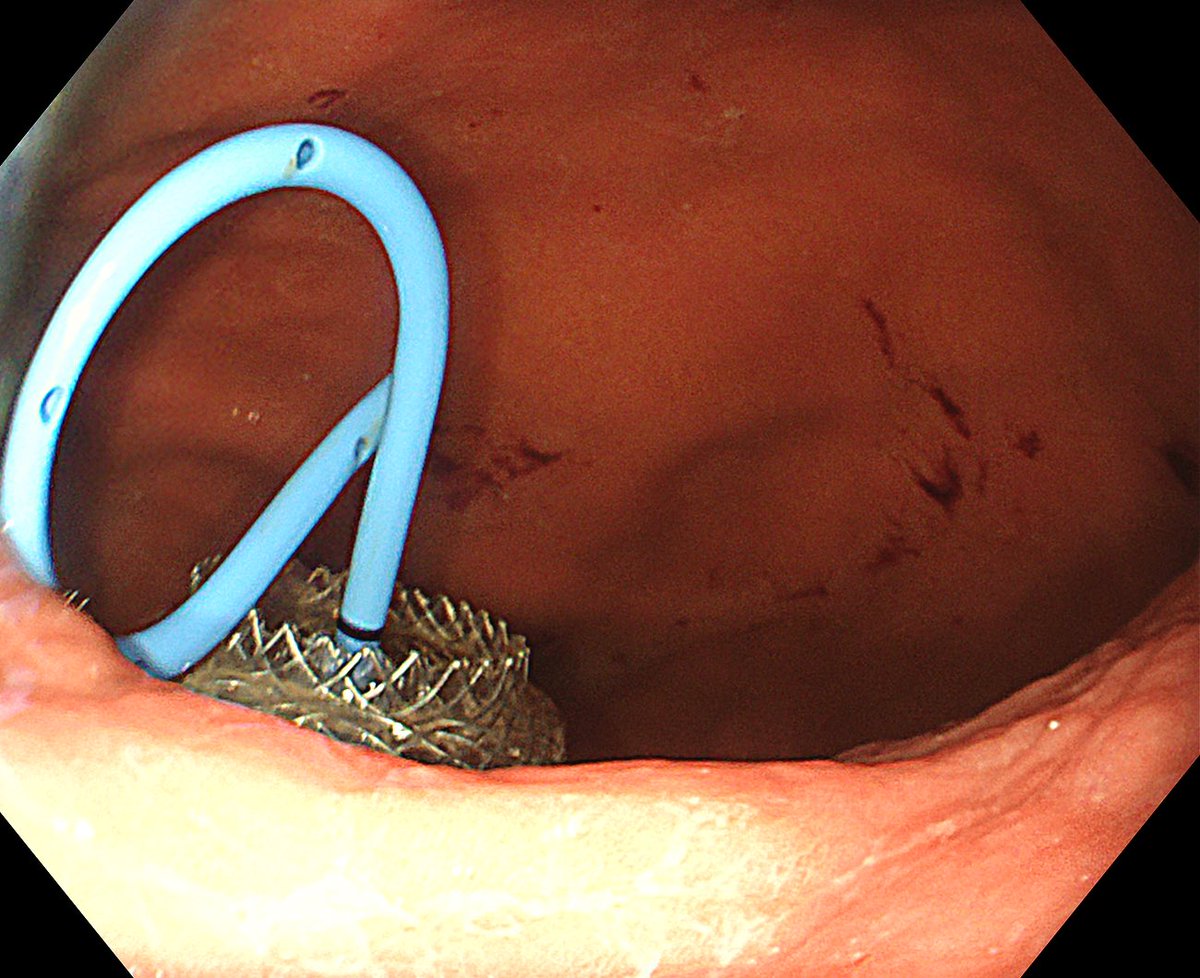 Large WON managed successfully with EUS CG using HOT AXIOS
<a href="/KIMS/">໊</a> hospital 
#KAGE Team