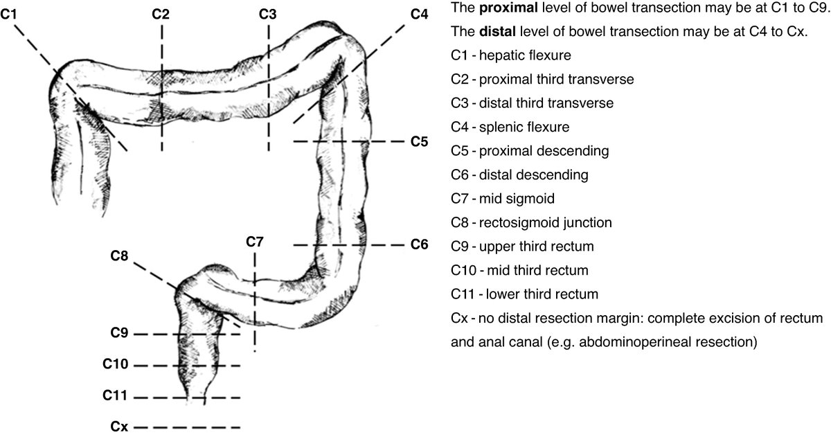 Anastomotic leak after manual circular stapled left-sided bowel surgery: analysis of technology-, disease-, and patient-related factors
➡️doi.org/10.1093/bjsope…

Across 3305 prospectively collected left-sided colorectal procedures involving a circular stapled anastomosis,