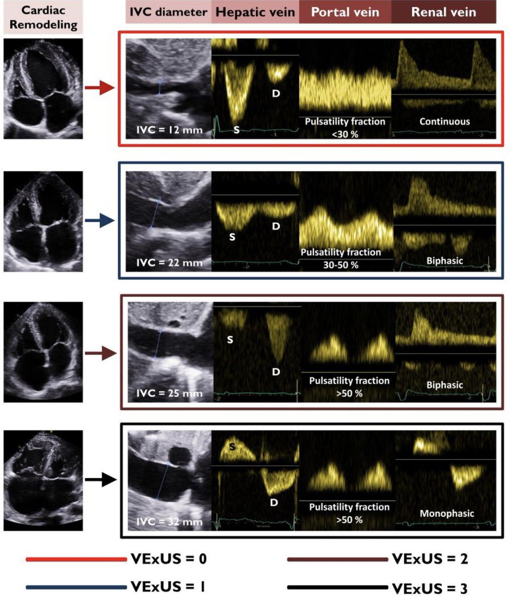 “Patients admitted with acute HF commonly had severe venous congestion based on the #VExUS score. The VExUS score improved the prediction of in-hospital mortality compared with other indices of venous congestion.”
#POCUS #FOAMed #Nephpearls 
🔗 sciencedirect.com/science/articl…