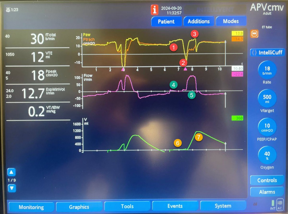 Breath by Breath: Educational Videos on Ventilator Mastery wix.to/pM0JtxY