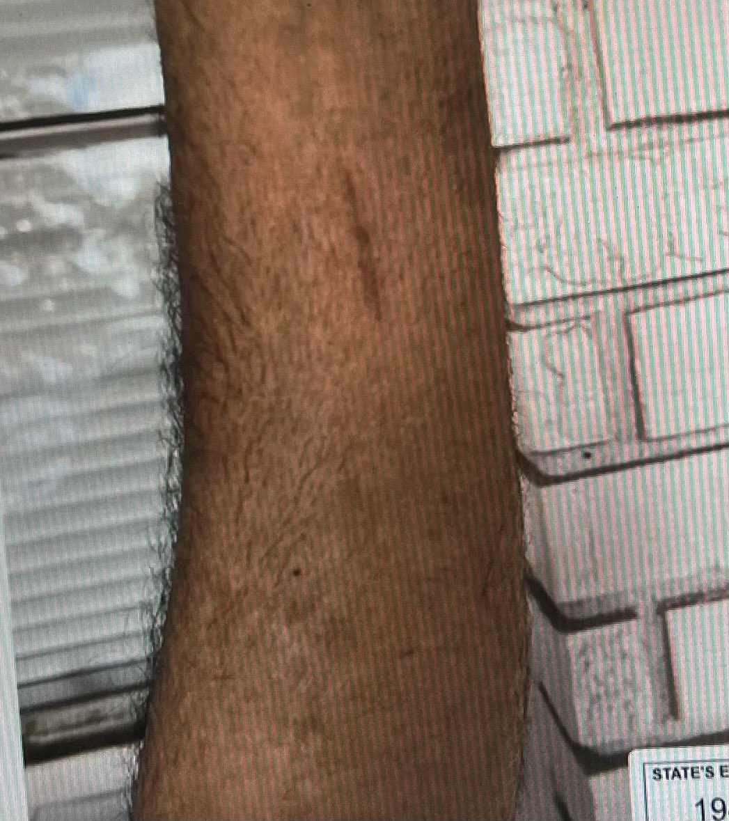 “She got him!” Special Prosecutor Sheila Ross about Laken Riley leaving scratches on her killer! “She marked him for everyone to see. For you to see!” #LakenHopeRiley