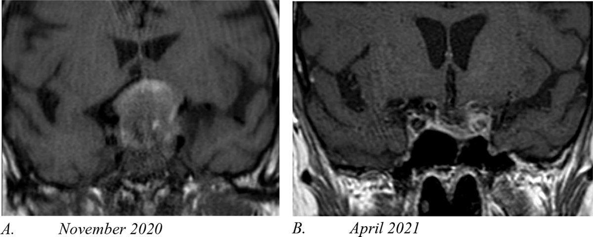 🔴 𝐎𝐭𝐫𝐨 𝐚𝐫𝐭𝐢́𝐜𝐮𝐥𝐨 𝐝𝐞 𝐫𝐞𝐯𝐢𝐬𝐢𝐨́𝐧 𝐪𝐮𝐞 𝐦𝐮𝐞𝐬𝐭𝐫𝐚 𝐜𝐨́𝐦𝐨 𝐞𝐥 𝐡𝐢𝐩𝐨𝐩𝐢𝐭𝐮𝐚𝐫𝐢𝐬𝐦𝐨 𝐩𝐨𝐝𝐫𝐢́𝐚 𝐬𝐞𝐫 𝐥𝐚 𝐜𝐥𝐚𝐯𝐞 𝐝𝐞𝐥 𝐝𝐞𝐬𝐚𝐫𝐫𝐨𝐥𝐥𝐨 𝐝𝐞 𝐋𝐨𝐧𝐠 𝐂𝐎𝐕𝐈𝐃.

“Interestingly, pituitary defects may persist long after the initial