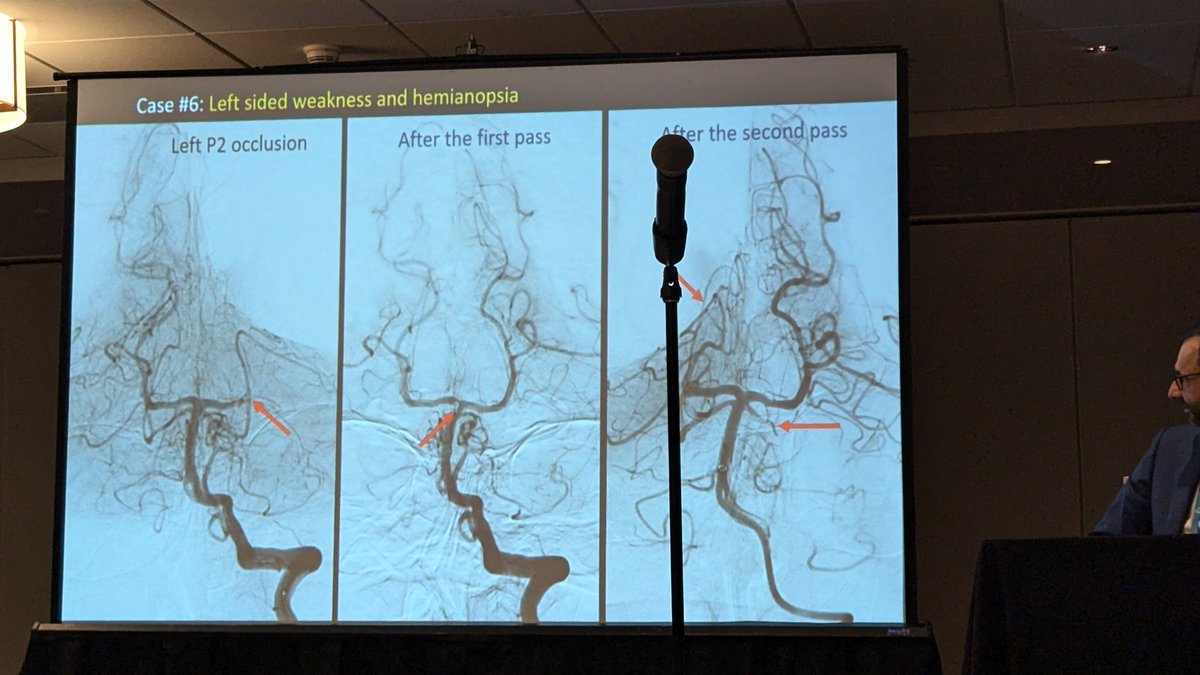 Vikalpa Dammavalam (@vikalpadamm) on Twitter photo 🧠 <a href="/AbdalkaderMD/">Mohamad AbdalKader</a> presents interesting neuroangiographic variants and their stroke complications.
💥Duplicate MCA
💥Twig like MCA
💥Fenestrations
💥Fetal PCA
💥Persistent Trigeminal & Hypoglossal Artery
#SVIN24 <a href="/svinsociety/">SVIN</a> <a href="/SVINJournal/">Stroke: Vascular and Interventional Neurology</a> <a href="/YoungNIR/">YoungNIR</a> <a href="/ESOstroke/">European Stroke Org</a> <a href="/MThrombectomy/">Mission Thrombectomy</a> 🧠 <a href="/AbdalkaderMD/">Mohamad AbdalKader</a> presents interesting neuroangiographic variants and their stroke complications.
💥Duplicate MCA
💥Twig like MCA
💥Fenestrations
💥Fetal PCA
💥Persistent Trigeminal & Hypoglossal Artery
#SVIN24 <a href="/svinsociety/">SVIN</a> <a href="/SVINJournal/">Stroke: Vascular and Interventional Neurology</a> <a href="/YoungNIR/">YoungNIR</a> <a href="/ESOstroke/">European Stroke Org</a> <a href="/MThrombectomy/">Mission Thrombectomy</a>
