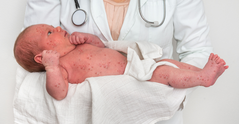 MedEdNetwork's tweet image. A new report released last week by the @WHO and the CDC has found that global measles cases surged by 20% in 2023, driven principally by inadequate vaccine coverage.

bit.ly/4fwtEHM

#publichealth #vaccination #infectiousdiseases #measles