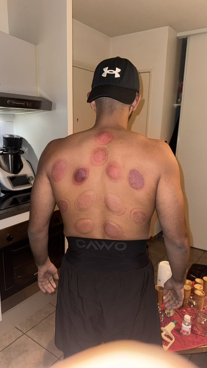 ilyescanor69's tweet photo. Les lyonnais j’vous donne le filon hijama du siècle, c’est un frère que j’connais, de confiance qui est formé et qui travaille qu’avec des produits de qualité, -10€ si vous lui dites que vous venez d’ma part j’ai mis son insta en 4eme photo ❤️❤️ https://t.co/Vtaf8ZMzr6