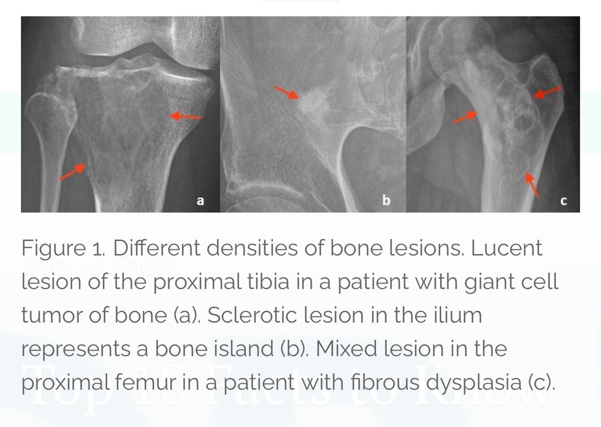 UMMCRads's tweet photo. Reading MSK radiographs &amp; don’t know where to start with a bone lesion? Check out the latest Journal of the @MSMA1 for “Top 10 Facts to Know about Bone Lesions Identified on Radiographs” by Dr. Robert Morris, some great residents &amp; @UMMCAdmitMD 🌟 student

https://t.co/aErJYwAIfA https://t.co/CJ8ff6OqtJ