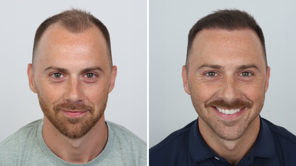 GoAdvancedHair's tweet photo. @elon_docs @elonmusk Can you please us at Advanced Hair Restoration where you had your hair transplant done? It looks great. Come visit us if you ever want a touch up. Our results are unrivaled  We have Texas locations! Drop us a a line at https://t.co/Ew6UfygxEr https://t.co/Z17vC1pihi