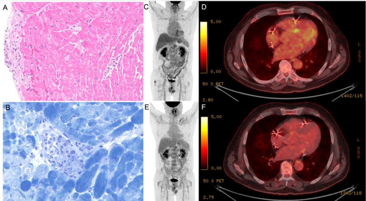 Circ: Heart Failure (@circhf) on Twitter photo The Great Masquerader – Diagnosing Cardiac Sarcoidosis in the Era of Advanced Cardiac Imaging <a href="/anguyen4194/">Andrew T. Nguyen</a> <a href="/Ron_Witteles/">Ronald Witteles</a> #AHAJournals ahajrnls.org/3Z2jffQ The Great Masquerader – Diagnosing Cardiac Sarcoidosis in the Era of Advanced Cardiac Imaging <a href="/anguyen4194/">Andrew T. Nguyen</a> <a href="/Ron_Witteles/">Ronald Witteles</a> #AHAJournals ahajrnls.org/3Z2jffQ