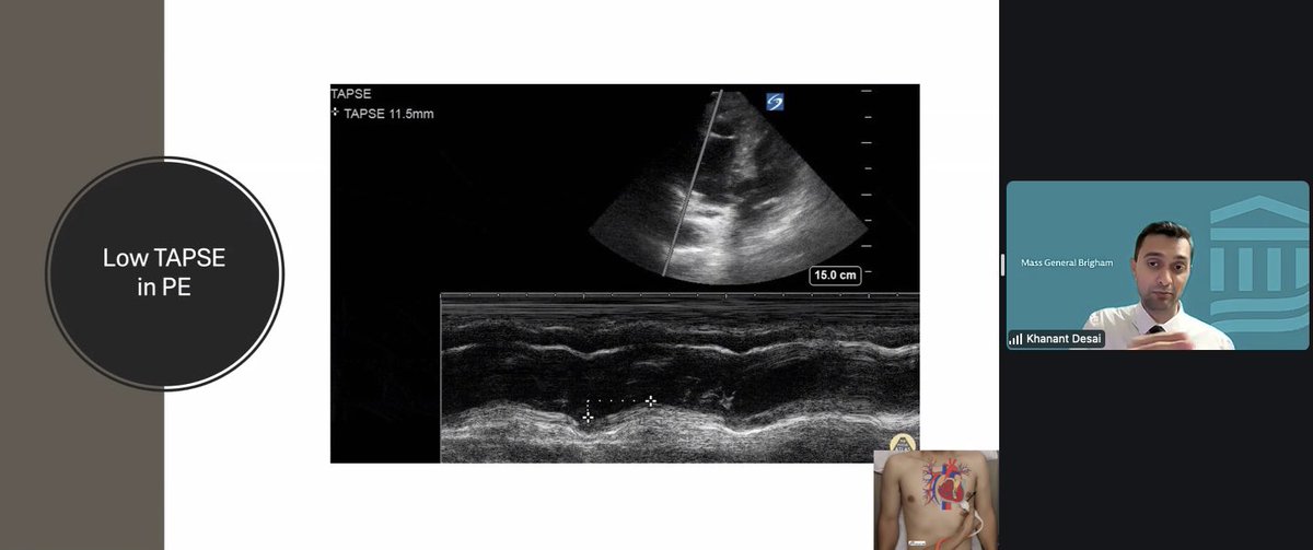 sajel_dutt's tweet photo. Just one of the many pearls from Dr. Desai’s lecture. We learned about cardiac ultrasound and its utility in identifying acute pathologies as a VIR. Excited to keep learning about this field through a clinical lens. https://t.co/FGQD7kwRV7