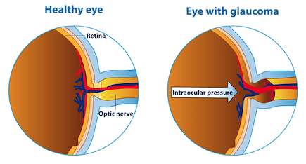 CarverJohns's tweet photo. Cannabis for Glaucoma

A study entitled "Cannabinoids for Treatment of Glaucoma" that was published in the journal Current Opinion in Ophthalmology investigated the potential efficacy of cannabis and its constituent cannabinoids and terpenes....

https://t.co/VstJEx3hHK https://t.co/32Hw6ygJFY