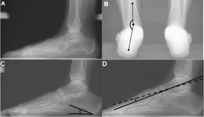 😃New article published in J Biomech!

"The Association Between Foot Morphology and Foot Loading During Gait", by Cotton et al

👀sciencedirect.com/science/articl…

#journalofbiomechanics