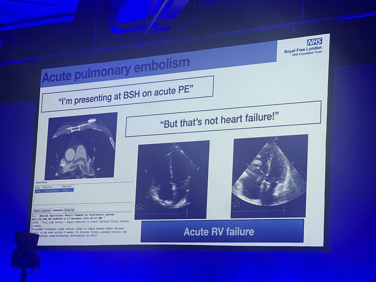 Ayisha Khan-Kheil (@khankheil88) on Twitter photo Another fantastic session <a href="/BSHeartFailure/">British Society for Heart Failure #theFword</a> on pulmonary hypertension 🫁 🫀 <a href="/RoyalFreeNHS/">Royal Free London</a> #BSH2024
➡️PH - when to refer/when to keep to yourself
➡️ CMR guided RHC for accurate cardiac output.
➡️ acute PE Another fantastic session <a href="/BSHeartFailure/">British Society for Heart Failure #theFword</a> on pulmonary hypertension 🫁 🫀 <a href="/RoyalFreeNHS/">Royal Free London</a> #BSH2024
➡️PH - when to refer/when to keep to yourself
➡️ CMR guided RHC for accurate cardiac output.
➡️ acute PE
