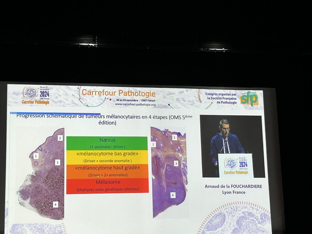 LiveLovePath's tweet photo. Great talk by @melanopath at #carrefourpathologie2024 about new entities in the 5th edition WHO classification of skin tumors #dermpath https://t.co/sa1oDveeIL