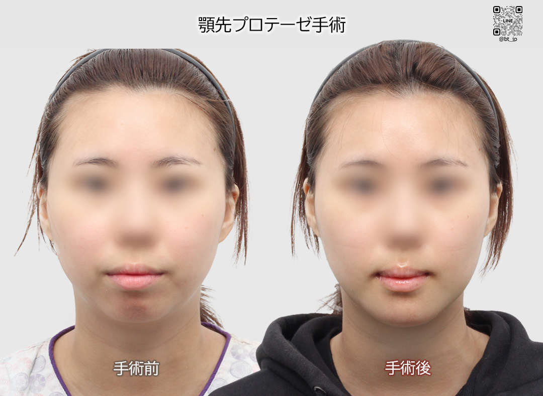輪郭と鼻整形専門」#BT整形外科 ☑#顎先プロテーゼ手術 プロテーゼで顎なし改善！ 顎先のボリュームを出しながら長さも出し、丸い顔の形から卵型に変わりました❤  🧑\u200d⚕️執刀医：日本語堪能 イ・ホビン院長💕 💬 公式LINE https://t.co/sotI1lGh1E #韓国整形 #渡韓整形 ..., image size:1080x789