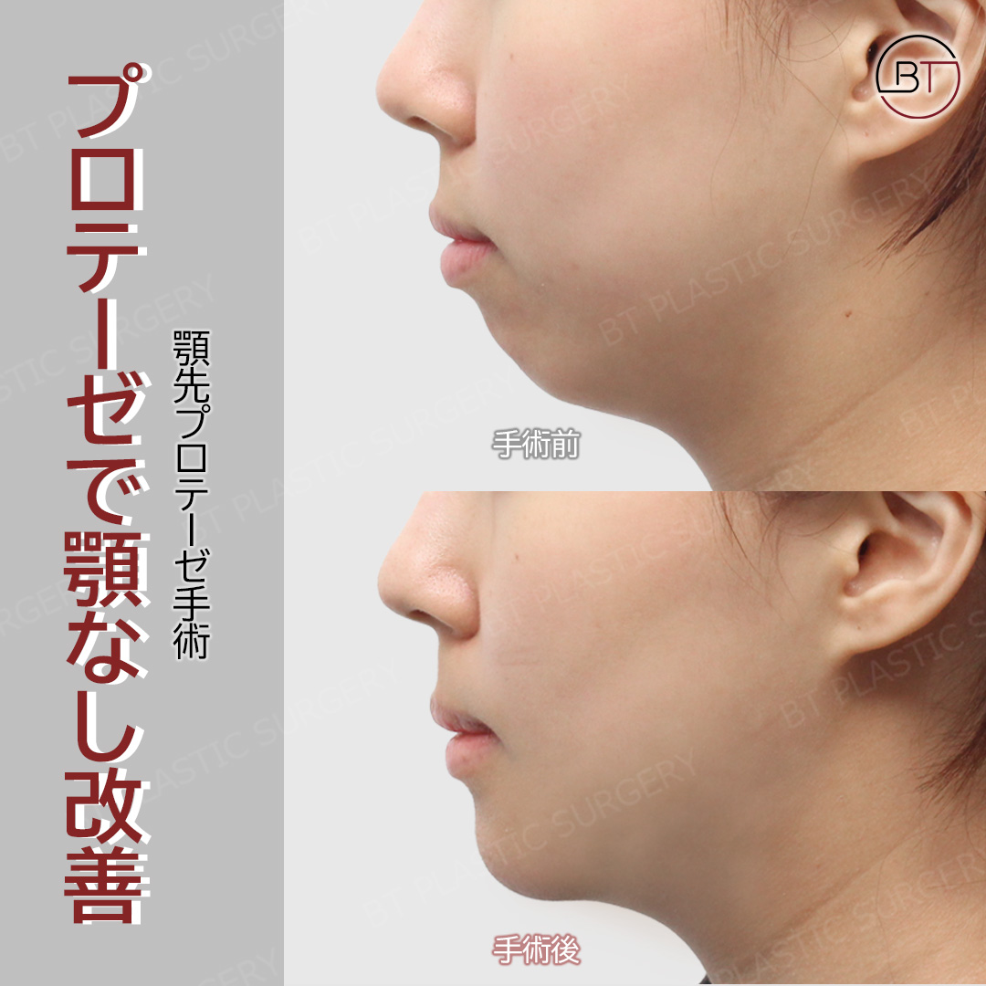 輪郭と鼻整形専門」#BT整形外科 ☑#顎先プロテーゼ手術 プロテーゼで顎なし改善！ 顎先のボリュームを出しながら長さも出し、丸い顔の形から卵型に変わりました❤  🧑\u200d⚕️執刀医：日本語堪能 イ・ホビン院長💕 💬 公式LINE https://t.co/sotI1lGh1E #韓国整形 #渡韓整形 ..., image size:1080x1080
