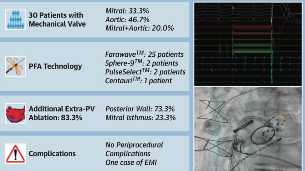 Domenico Giovanni Della Rocca, MD (@dogi84md) on Twitter photo Proud to share our multicenter study on the safety of #PFA in pts with mechanical valves. No complications but beware of electromagnetic interference hindering PFA delivery. Thanks to <a href="/Drdevignair/">Dr. Devi G Nair</a> <a href="/natale_md/">Andrea Natale MD</a> <a href="/michelefg91/">Michele Magnocavallo</a> @CdeAsmundis <a href="/SergeBoveda/">Serge Boveda</a> <a href="/AndreaSarkozy/">Andrea Sarkozy</a> @glowa_A Proud to share our multicenter study on the safety of #PFA in pts with mechanical valves. No complications but beware of electromagnetic interference hindering PFA delivery. Thanks to <a href="/Drdevignair/">Dr. Devi G Nair</a> <a href="/natale_md/">Andrea Natale MD</a> <a href="/michelefg91/">Michele Magnocavallo</a> @CdeAsmundis <a href="/SergeBoveda/">Serge Boveda</a> <a href="/AndreaSarkozy/">Andrea Sarkozy</a> @glowa_A