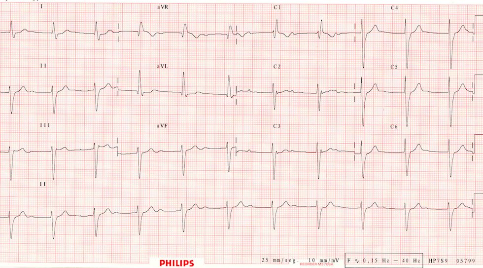 Seguimos con los bloqueos. Las siglas son HBAI (hemibloqueo anterior izquierdo), BRD (bloqueo de rama derecha) , BRI (bloqueo de rama derecha), 1G (primer grado). Ahora leer este ECG y a interpretar.