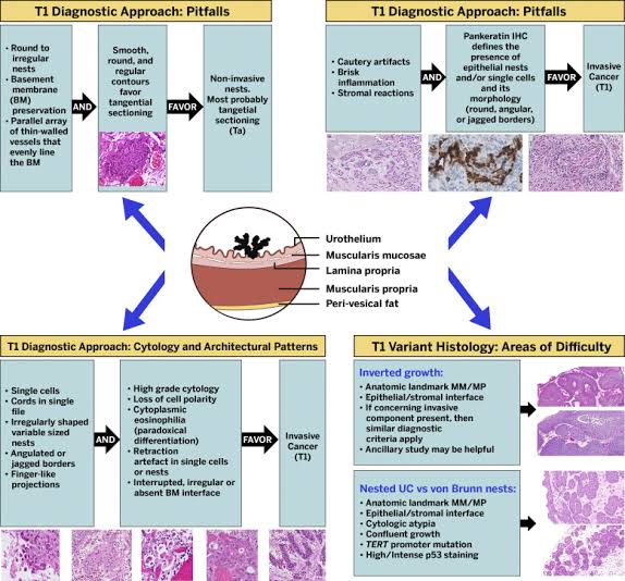 ⚡️ Stage T1 bladder cancer: diagnostic criteria and pitfalls 

#BladderCancer 

sciencedirect.com/science/articl…