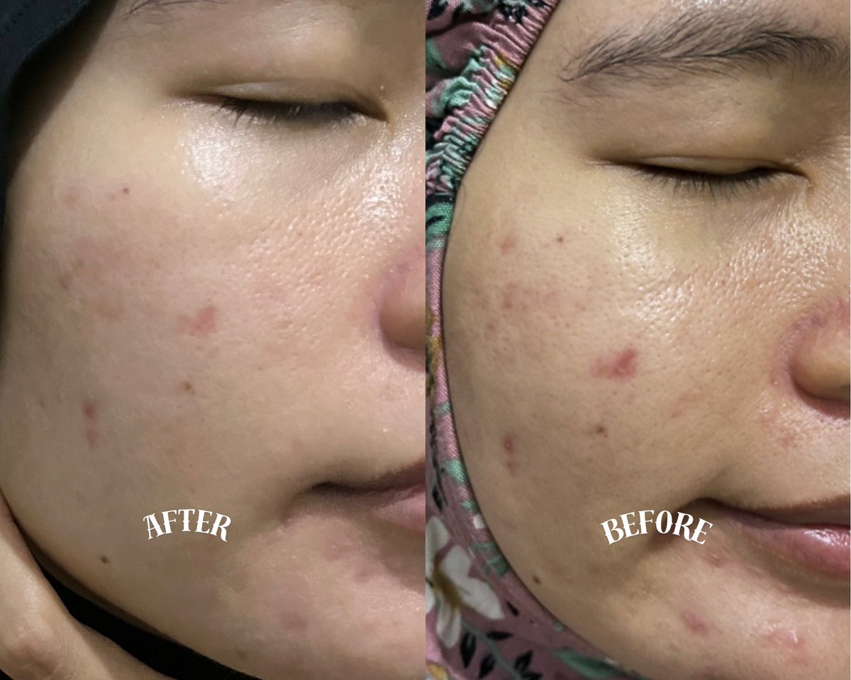 umslimoon's tweet photo. GAK SIA SIA aku pantengin 24 jam karena war serum ini biar gak kehabisan dan dapet harga promo🫵

Vitamin C teringan 2024 yang aku punya ini jatuh kepada @AzarineCosmetic C GLOW SERUM
yang super ringan ini https://t.co/kYQWwkFM6o