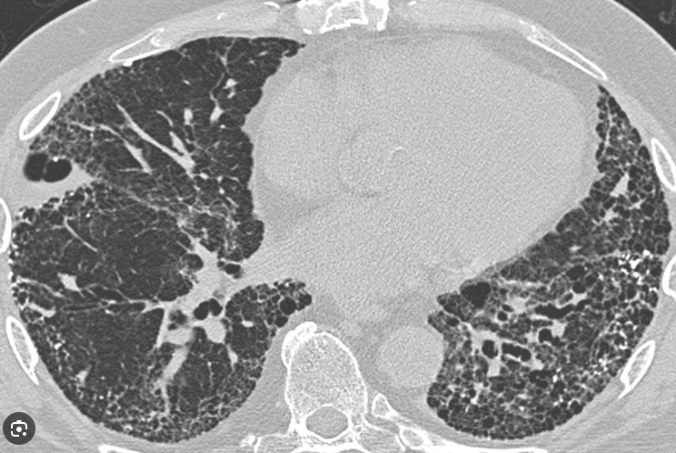 Vanessa Kronzer, MD (@kronzermd) on Twitter photo Hot off the press in @ARD_BMJ: new gene-respiratory disease endotypes that may drive #rheumatoidarthritis. This includes top genes to test in people with #ild for RA risk. Special thanks to mentors <a href="/jeffsparks/">Jeffrey Sparks MD MMSc</a> <a href="/JohnDavisIII/">John M. Davis III, MD MS</a>. Check it out here!
pubmed.ncbi.nlm.nih.gov/39486873/ Hot off the press in @ARD_BMJ: new gene-respiratory disease endotypes that may drive #rheumatoidarthritis. This includes top genes to test in people with #ild for RA risk. Special thanks to mentors <a href="/jeffsparks/">Jeffrey Sparks MD MMSc</a> <a href="/JohnDavisIII/">John M. Davis III, MD MS</a>. Check it out here!
pubmed.ncbi.nlm.nih.gov/39486873/