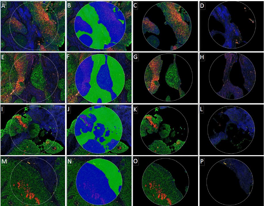 Visiopharm (@visiopharm) on Twitter photo Discover how AI-powered automation in spatial profiling helps explore hypoxia's impact on head and neck cancer. Visiopharm's Oncotopix + GeoMx DSP enables high-throughput and unbiased insights into TME! <a href="/brukerspatial/">Bruker Spatial Biology</a> hubs.ly/Q02YGYtH0 Discover how AI-powered automation in spatial profiling helps explore hypoxia's impact on head and neck cancer. Visiopharm's Oncotopix + GeoMx DSP enables high-throughput and unbiased insights into TME! <a href="/brukerspatial/">Bruker Spatial Biology</a> hubs.ly/Q02YGYtH0