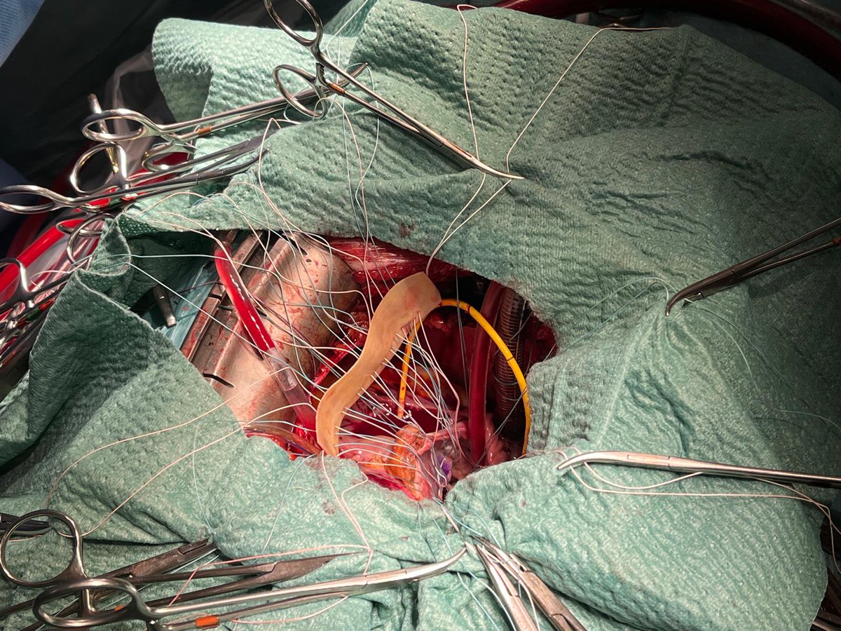 Cardiac Surgery Gregorio Marañon Hospital tweet media