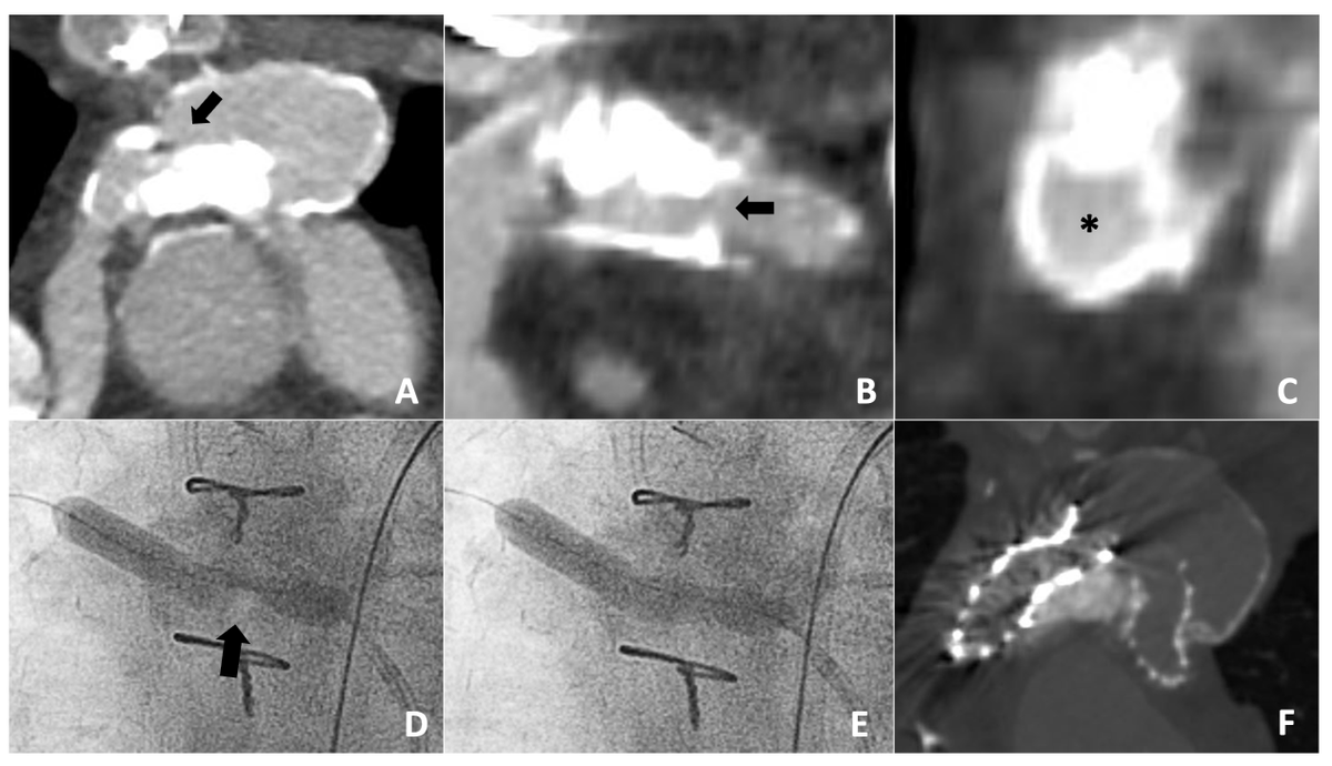 InvasiveCardiol's tweet photo. Read now: Intravascular #Lithotripsy -Assisted Intervention in Patients With #CongenitalHeartDisease 👉 https://t.co/VAvgMiqQ2G
@DLBHATTMD #cardioTwitter #cardioX #cardiology #interventionalcardiology https://t.co/gd8j1ufMUV