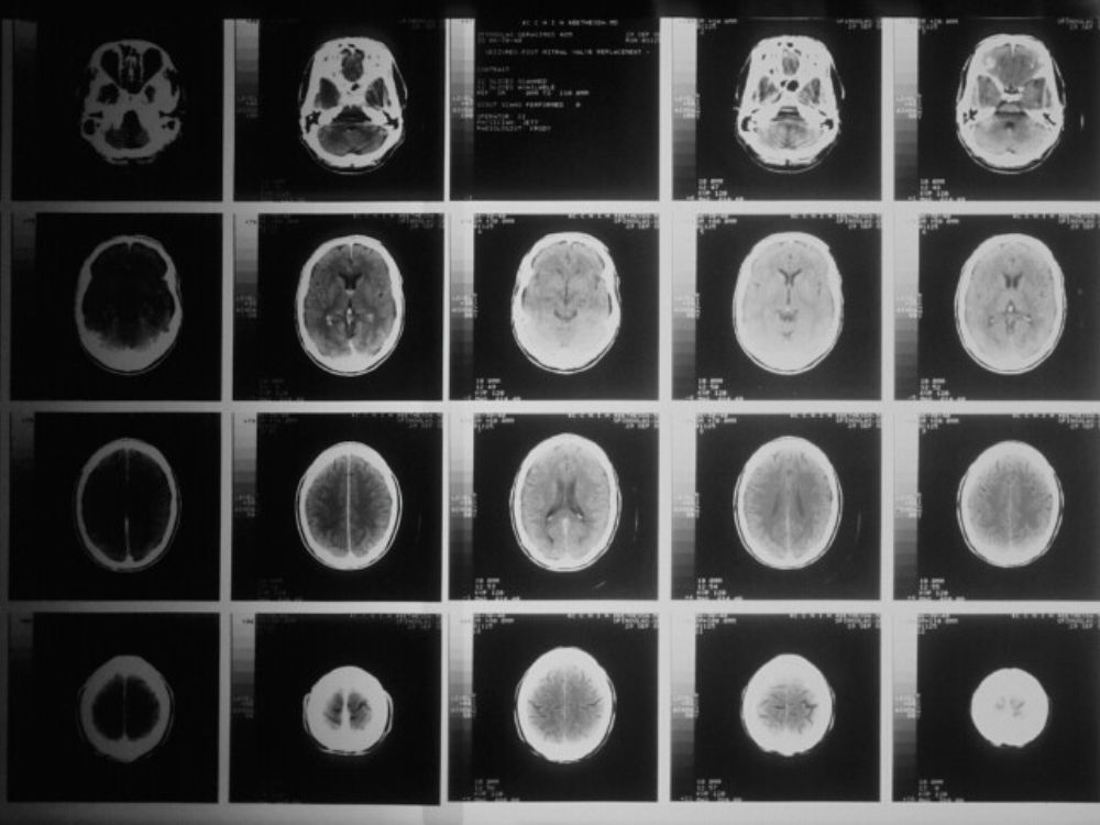 UK Dementia Research Institute tweet media