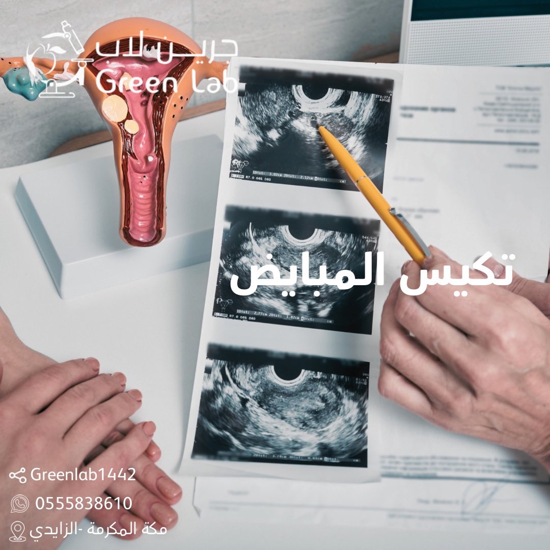 greenlab1442's tweet photo. هو أكثر الاضطرابات الهرمونية شيوعا لدى السيدات ويحدث حين الحويصلات الخاصة بالتبويض تنحبس تحت سطح المبيض مباشرة وتبقى غير قادرة على تحرير البويضات منها فتتحول الى اكياس صغيرة متعددة.
.
.
#تكيس_المبايض #صحتك_تهمنا https://t.co/YoPhXR0ydO