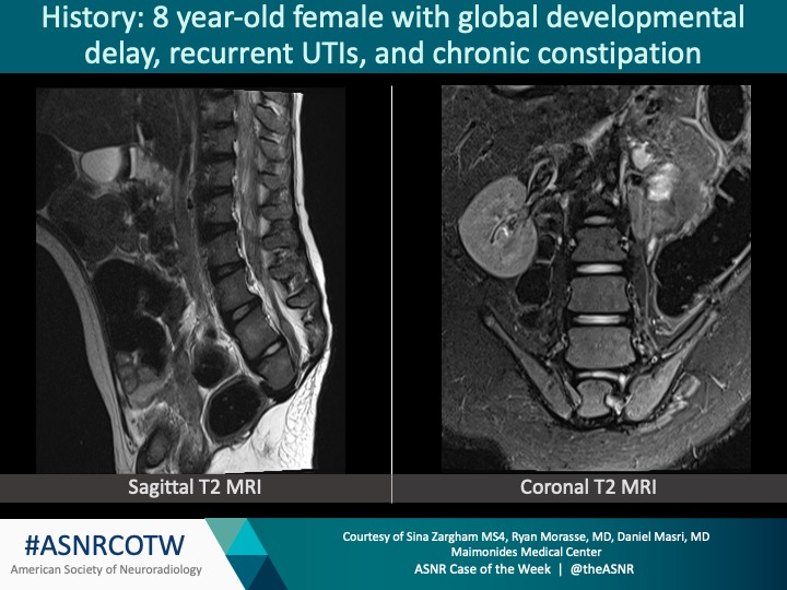 ASNR COTW #222   

Hx: 8 yoF with global developmental delay, recurrent UTIs, chronic constipation

NO SPOILERS! Give hints in the form of GIFs or answer  poll. Answer in 24 hours.                  

#neuro #neurorad #radres #FOAMed #FOAMrad #medtwitter #ASNRCOTW <a href="/MMCRadRes/">Maimonides Radiology Residency</a>