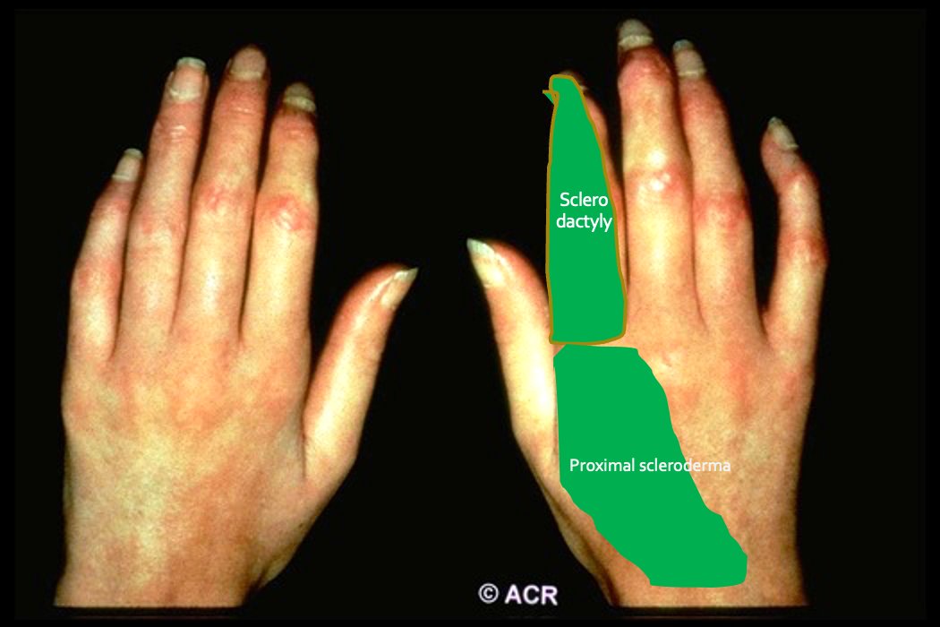 When is it SSc vs. not on physical examination
✅Skin thickness over fingers (sclerodactyly)+ proximal to MCP joints. 
❌ Skin thickness sparing fingers but involving limbs/ torso is not SSc