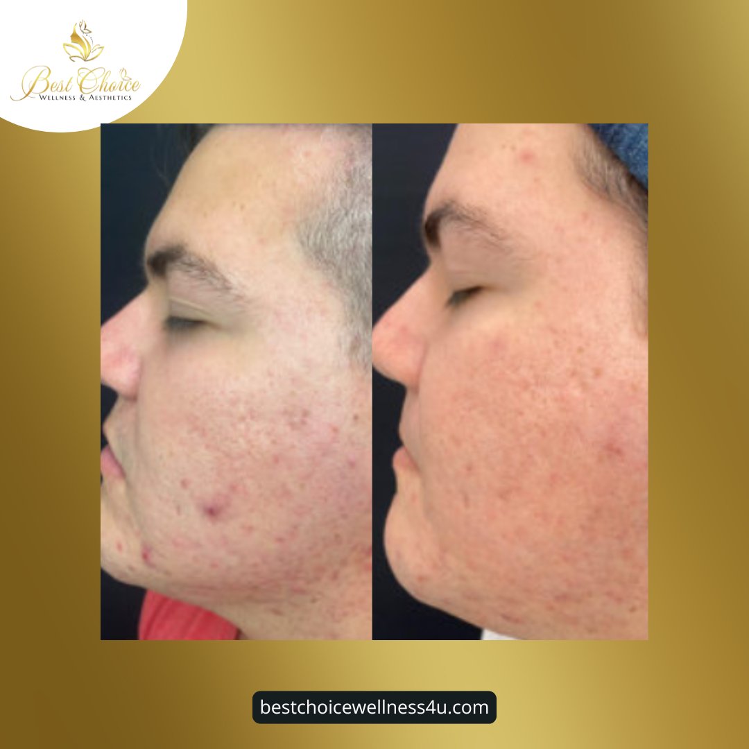 BWellness4u's tweet photo. Glow Goals Achieved! ✨

See this stunning before &amp; after transformation with microneedling! 🌟 Reveal smoother, brighter, and rejuvenated skin that speaks for itself.

Ready to start your journey to flawless skin? Book your session today and let your confidence shine! https://t.co/gsnPJnN72c