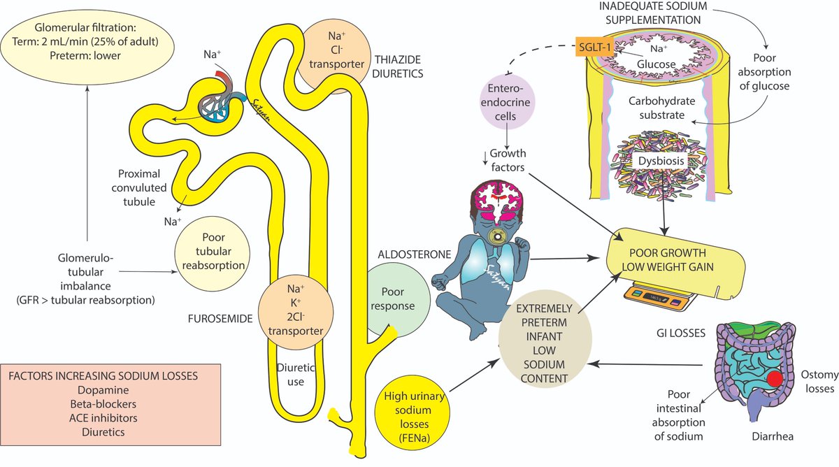 Satyan (@neosatyan) on Twitter photo A pinch of salt to promote growth in preterm infants? Do you provide sodium supplements based on Urine sodium to your tiny preemies? Editorial in <a href="/JPerinatology/">Journal of Perinatology</a> by Dr. Steflik et al rdcu.be/d00Ic comment on Stalter et al <a href="/UIowaPeds/">UI Stead Family Department of Pediatrics</a> protocol rdcu.be/d00Jq A pinch of salt to promote growth in preterm infants? Do you provide sodium supplements based on Urine sodium to your tiny preemies? Editorial in <a href="/JPerinatology/">Journal of Perinatology</a> by Dr. Steflik et al rdcu.be/d00Ic comment on Stalter et al <a href="/UIowaPeds/">UI Stead Family Department of Pediatrics</a> protocol rdcu.be/d00Jq