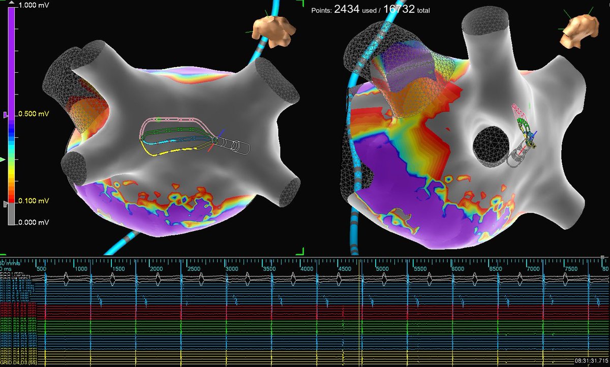 Mallory Taylor (@pvc_on_hers) on Twitter photo From the veins to the posterior wall,
No conduction into the LA at all! 🔥
Veins on (independent) fire, but full entrance/exit block observed on #HDGrid thanks to great work by <a href="/Dr_Niazi/">Osama Tariq Niazi</a>!
#EnSiteX #AbbottAF <a href="/AbbottCardio/">Abbott Cardiovascular</a> <a href="/jimmybarth76/">Jimmy Barth</a> From the veins to the posterior wall,
No conduction into the LA at all! 🔥
Veins on (independent) fire, but full entrance/exit block observed on #HDGrid thanks to great work by <a href="/Dr_Niazi/">Osama Tariq Niazi</a>!
#EnSiteX #AbbottAF <a href="/AbbottCardio/">Abbott Cardiovascular</a> <a href="/jimmybarth76/">Jimmy Barth</a>