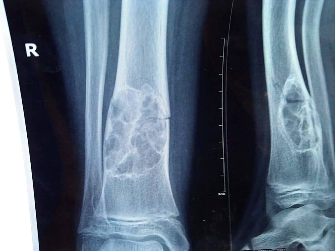 10 y/m
Would you fix and graft it immediately after the fracture occurs, or would you let it heal first?
#orthotwitter 
<a href="/InvictaOrtho/">Yelena Bogdan, MD, FACS, FAAOS</a> <a href="/Davembmd/">dave</a> <a href="/aberizzi/">antonio berizzi</a> <a href="/bonesmith_/">Haseeb Gani</a> <a href="/anklefootmd/">Lance Silverman, MD FAAOS</a> <a href="/FootAndAnkleMD/">FootAndAnkleMD</a>
