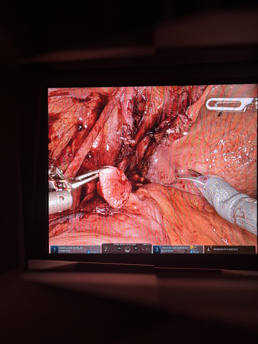 Greg Kyriazis (@greg_kyriazis) on Twitter photo Nice robotic case, distal ureterectomy and re implantation for ureteric tcc. ICG is helpful at these cases to determine healthy ureter @DosMyht <a href="/MYHTUrology/">MYHTUrology</a> <a href="/IntuitiveSurg/">Intuitive</a> <a href="/surgicalrobo/">Surgical Robotics Technology</a> Nice robotic case, distal ureterectomy and re implantation for ureteric tcc. ICG is helpful at these cases to determine healthy ureter @DosMyht <a href="/MYHTUrology/">MYHTUrology</a> <a href="/IntuitiveSurg/">Intuitive</a> <a href="/surgicalrobo/">Surgical Robotics Technology</a>