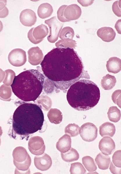 CuringN's tweet photo. Bone marrow neoplastic - What's your diagnosis?

Topic link: https://t.co/s0TEQhjZeX

Images contributed by Hatem Kaseb, M.D., Ph.D., M.P.H. and AFIP

Read cancer-related essays by Dr. Pernick: https://t.co/aaLBk9BA8J.

#Cancer #CancerResearch #CuringCancerNetwork #Pathology https://t.co/juSG0kUQkF