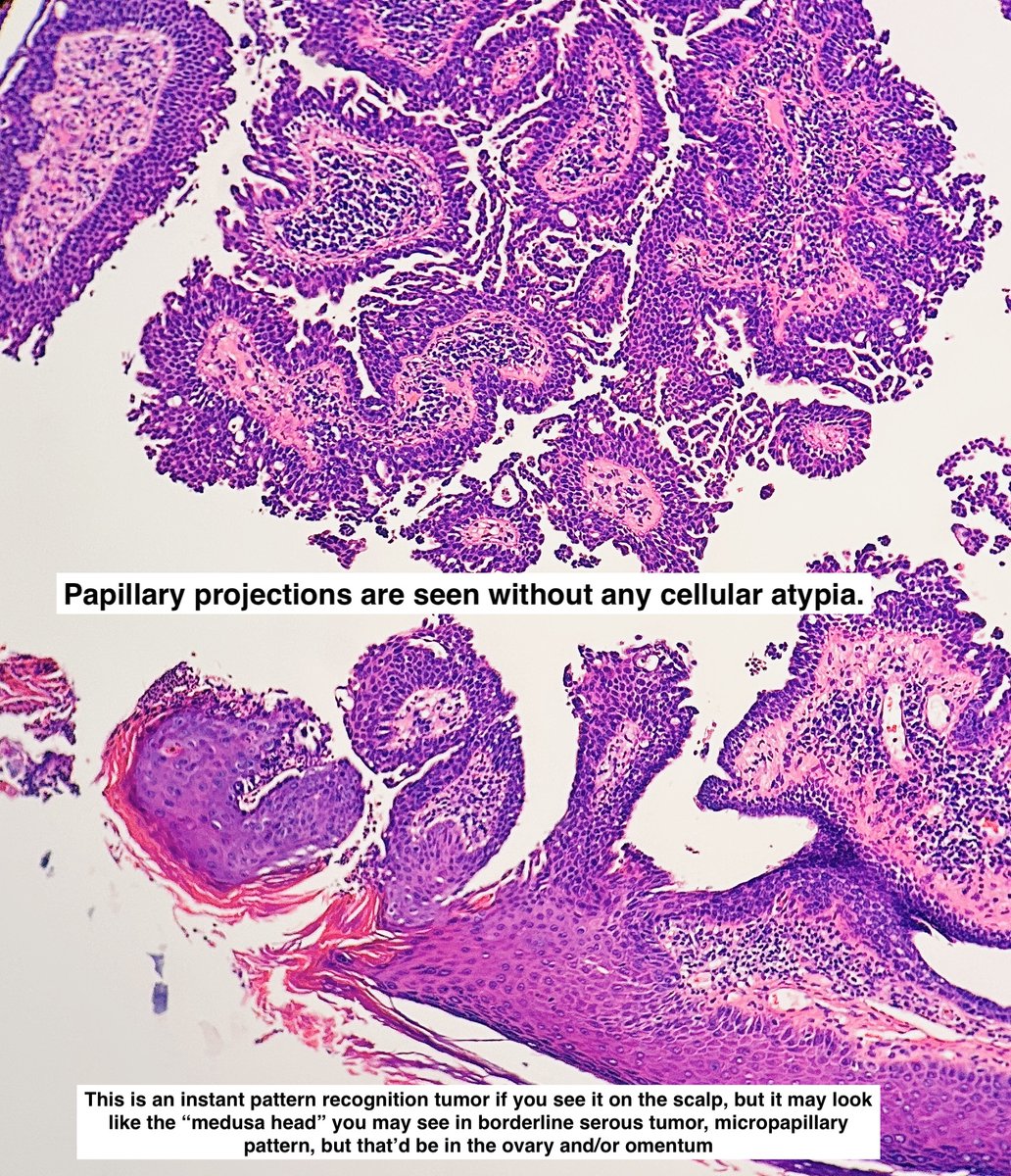 Path4People's tweet image. I am a benign, rare adnexal tumor

I like to be on the scalp/face and may be associated with nevus sebaceus

You may see a lot of plasma cells in me

Who am I? 🤔 

#pathx #dermpath #fammed #medx #path4people #pathagonia