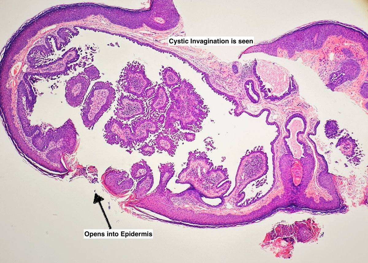Path4People's tweet image. I am a benign, rare adnexal tumor

I like to be on the scalp/face and may be associated with nevus sebaceus

You may see a lot of plasma cells in me

Who am I? 🤔 

#pathx #dermpath #fammed #medx #path4people #pathagonia
