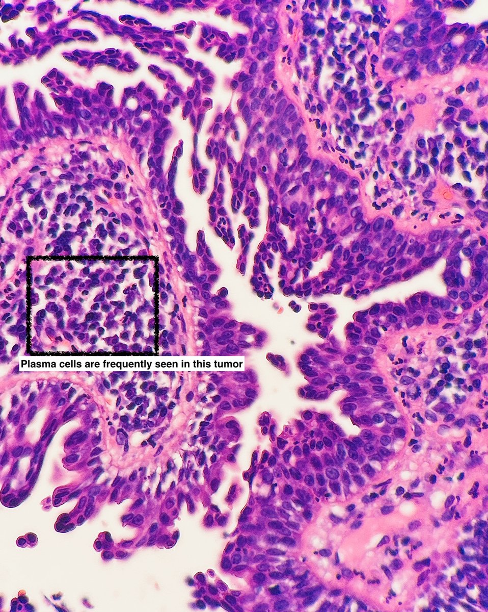 Path4People's tweet image. I am a benign, rare adnexal tumor

I like to be on the scalp/face and may be associated with nevus sebaceus

You may see a lot of plasma cells in me

Who am I? 🤔 

#pathx #dermpath #fammed #medx #path4people #pathagonia