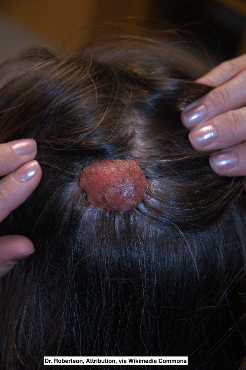 Path4People's tweet image. I am a benign, rare adnexal tumor

I like to be on the scalp/face and may be associated with nevus sebaceus

You may see a lot of plasma cells in me

Who am I? 🤔 

#pathx #dermpath #fammed #medx #path4people #pathagonia