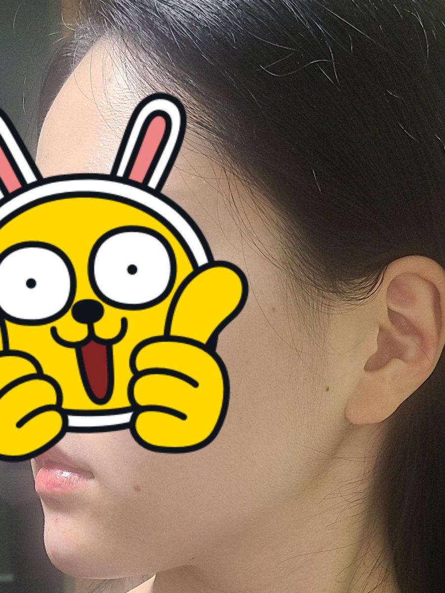 手術名 -エラ削り、顎の筋肉切除術
麻酔方法 - 全身麻酔
術後三か月目

あごの筋肉が発達した方には、あごの筋肉切除術を一緒におすすめします。
(周期的にエラボトックスを打たなくてもいいです。)

#形成外科 #皮膚科 #輪郭成形 #輪郭手術 #エラ削り#あごの手術
#整形前後#整形手術