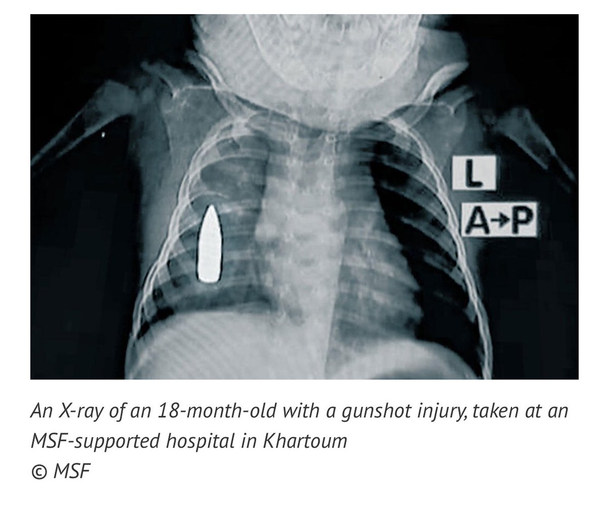 DrJasonBegalke's tweet image. Thinking of all women and children living in conflict zones across the globe.  

#WhenSecondsCount #MedEd #MedX #HealthCare #Sudan #HopeForHealthCare