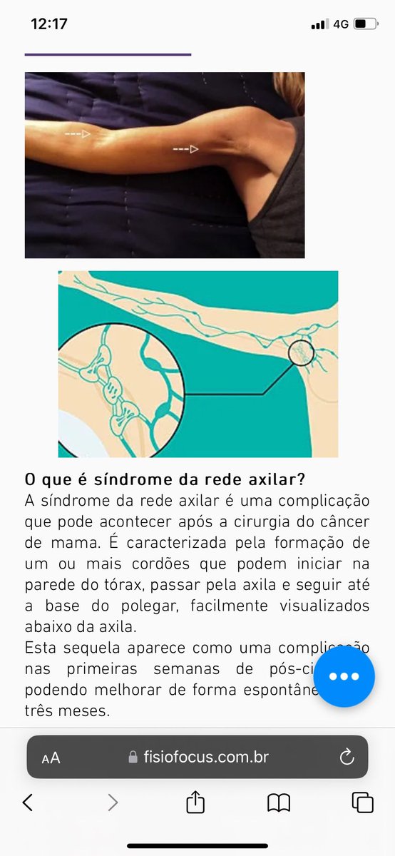 m_isco's tweet photo. Daí rolou isso aqui, uma coisa que é bem do pós cirúrgico mas me deu agora por conta dessa treta. Chama síndrome da rede axilar, basicamente criou-se um tendão só da minha mão até o meu subaco e parece uma cordinha curta com pouca mobilidade. É doido que da pra sentir exatamente https://t.co/pcSl9LHPHH